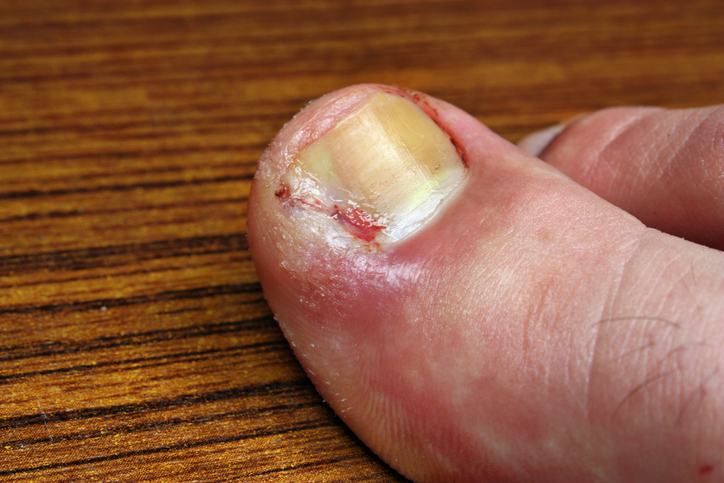 Ingrown Toenails - Symptoms causes and treatment by FHP Group